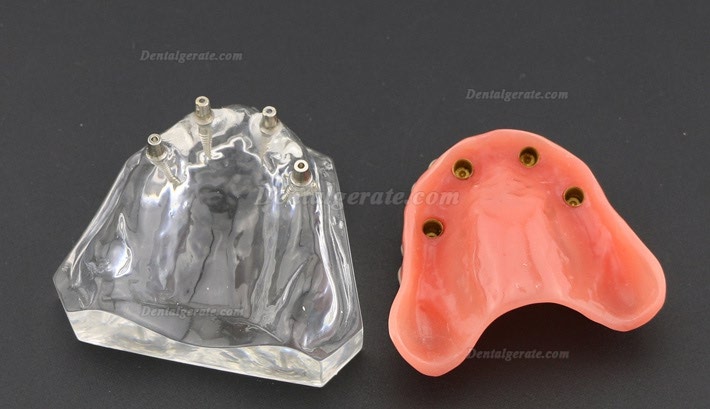 Anatomisches Modell der Zahnz&auml;hne &Uuml;berprothese Superior mit 4 Implantaten Demo Modell 6001